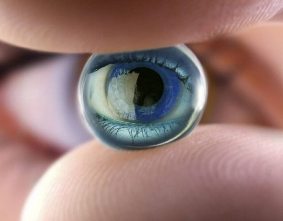 Orthokeratologie Nuecht Lënsen stoppen de Fortschrëtt vun der visueller Behënnerung